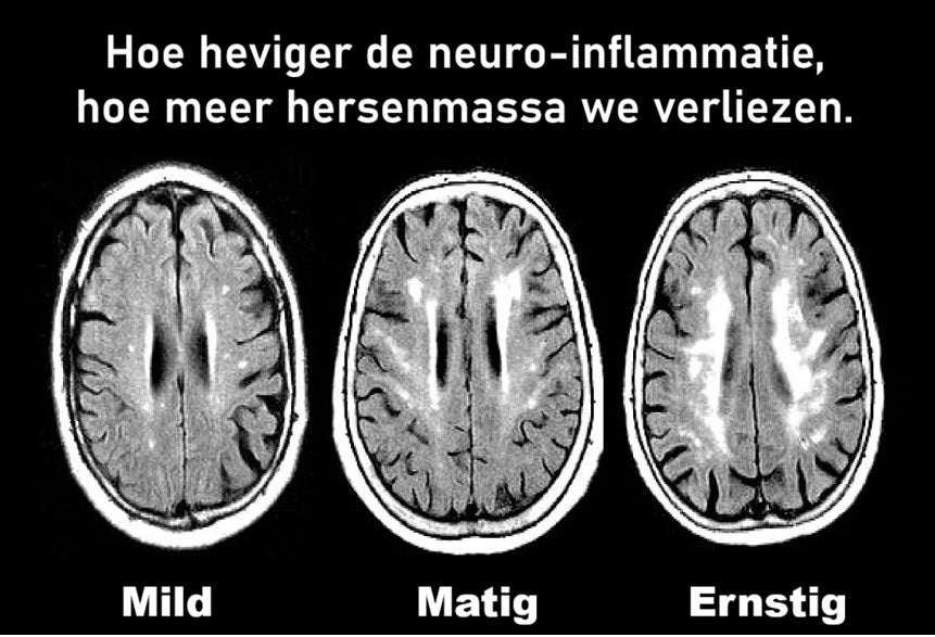 Hersenscans bij milde, matige en ernstige neuro-inflammatie